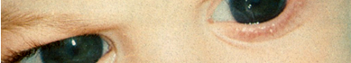 Enfermedad de Alpers