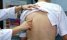 El sol causa 700 muertes cada año