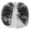 Primera encuesta a los afectados por cáncer de pulmón