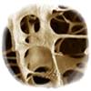 La Osteoporosis afecta en España a 1 de cada 3 mujeres