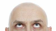 Hablamos de... Alopecia