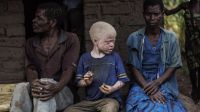 No somos animales para cazar o vender: somos albinos