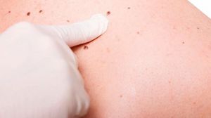 Detectar melanomas con inteligencia artificial ya es posible