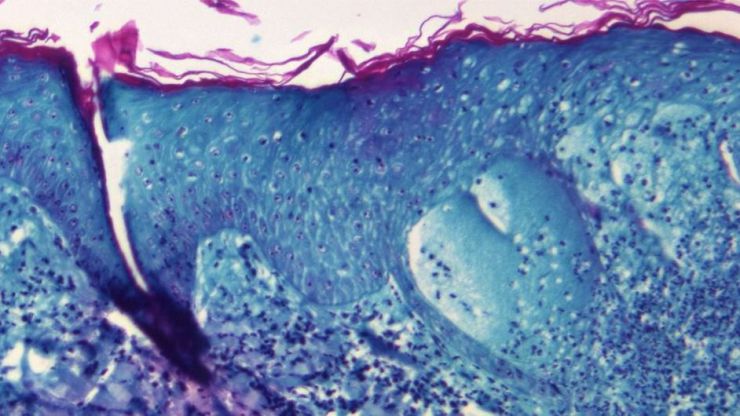 ¿Vacunación masiva contra la viruela del mono?: Solo cuando ha habido exposición