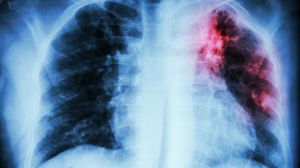 10,6 millones de personas enfermaron de tuberculosis y 1,3 murieron en 2022