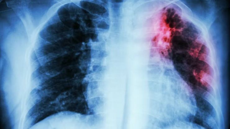 10,6 millones de personas enfermaron de tuberculosis y 1,3 murieron en 2022