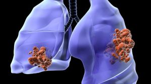 Una de las causas de resistencia a la inmunoterapia del cáncer de pulmón al descubierto