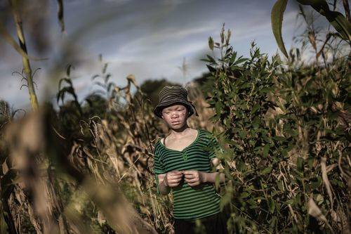 No somos animales para cazar o vender: somos albinos