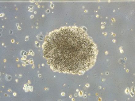 Nuevo mecanismo molecular descubierto que afecta la eficacia de la quimioterapia