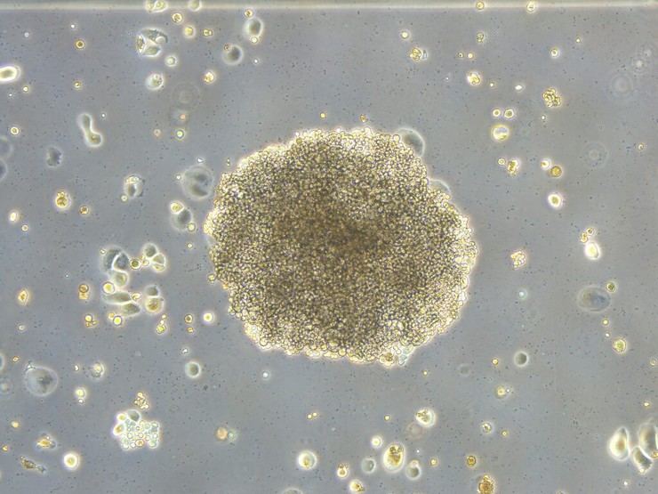 Nuevo mecanismo molecular descubierto que afecta la eficacia de la quimioterapia