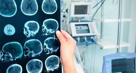 Impacto del Alzheimer en el cerebro: cambios y áreas afectadas