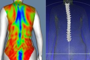 IBV innova en el diagnóstico de deformidades vertebrales con escaneo corporal dinámico