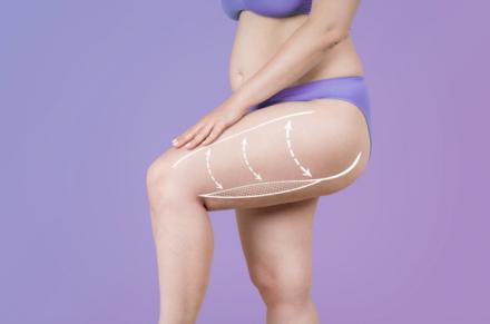 Lipedema: síntomas, tipos y grados de una enfermedad desconocida