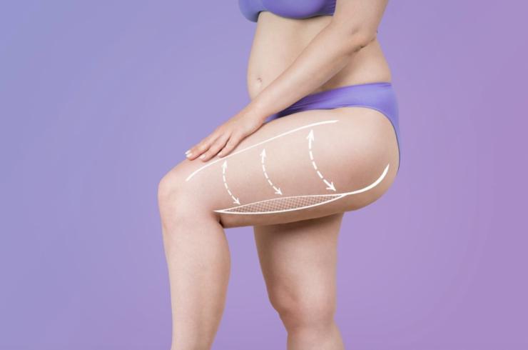 Lipedema: síntomas, tipos y grados de una enfermedad desconocida