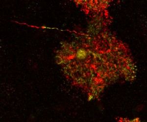 Descubren que células cerebrales antes consideradas sanas son patológicas