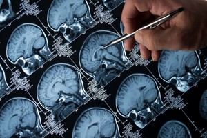 Investigadores del CSIC identifican el origen de corrientes eléctricas en cerebros de pacientes con epilepsia