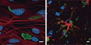 Nuevo modelo celular acelera la investigación sobre la enfermedad de Lafora, una epilepsia sin cura