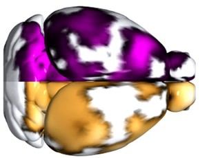 Detectan microtrombos en el cerebro de pacientes con Alzheimer mediante nueva técnica de imagen no invasiva
