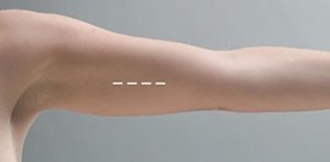 Anticonceptivos intradérmicos financiados por sanidad